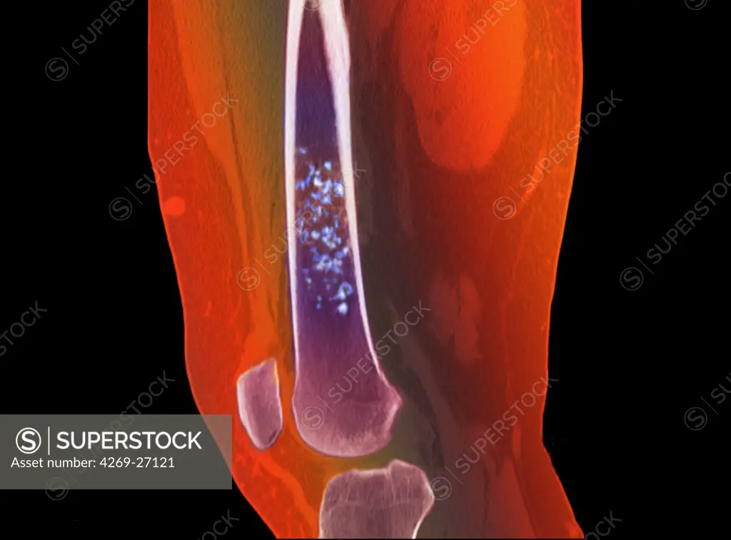 Chondroma. Color enhanced Computed Tomography (CT) scan of the leg showing a chondroma of the femur (thigh bone). This benign bone tumor is formed by a calcified cartilage matrix giving the bone marrow its spotted aspect (in blue).