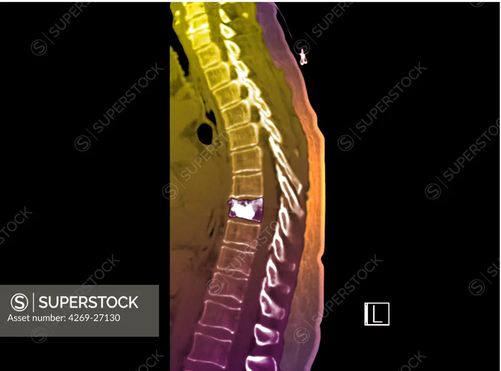 Kyphoplasty. Color enhanced sagittal computed tomography (CT) scan of the spine showing vertebral compaction due to osteoporosis after treatment by kyphoplasty.