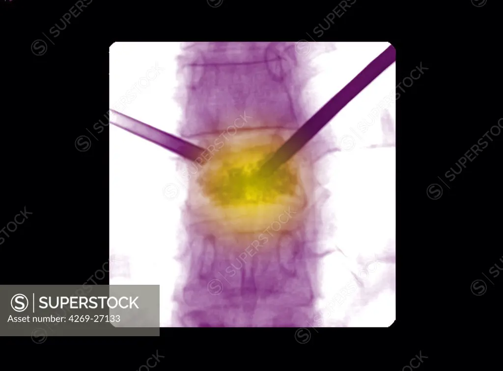 Kyphoplasty. Colored X-ray of the spine of a patient with vertebral compaction due to osteoporosis treated by kyphoplasty.