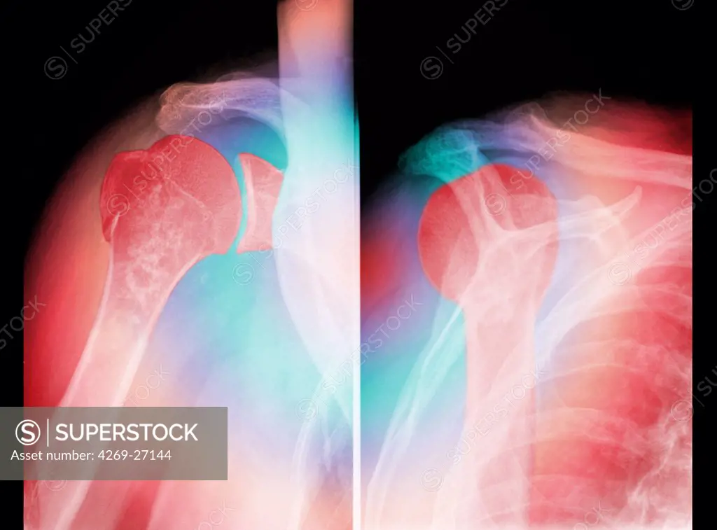Shoulder luxation. Colored X-ray showing a complete inferior dislocation of the shoulder. At left : normal position of the head of the humerus (upper arm bone in red) in the glenoid cavity (socket) of the scapula (shoulder blade). At right, the head of the humerus has slipped out backwards (inferior dislocation) of its socket in the shoulder blade.