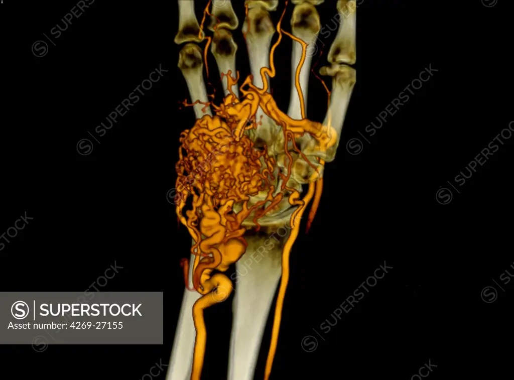 Arteriovenous malformation. Color enhanced 3D computed tomography (CT) scan of the left hand showing a malformation of the arteriovenous vessels in the palme, at the base of the finger (orange nodules), obstructing the flow of the radial artery below.