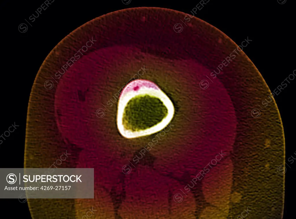 Osteoid osteoma. Color enhanced axial computed tomography (CT) scan of the thigh showing osteoid osteoma (benign bone tumor) on the femur. The osteoid osteoma is revealed by a thickening of the bone connective tissues (pink) at the surface of the femur (white).