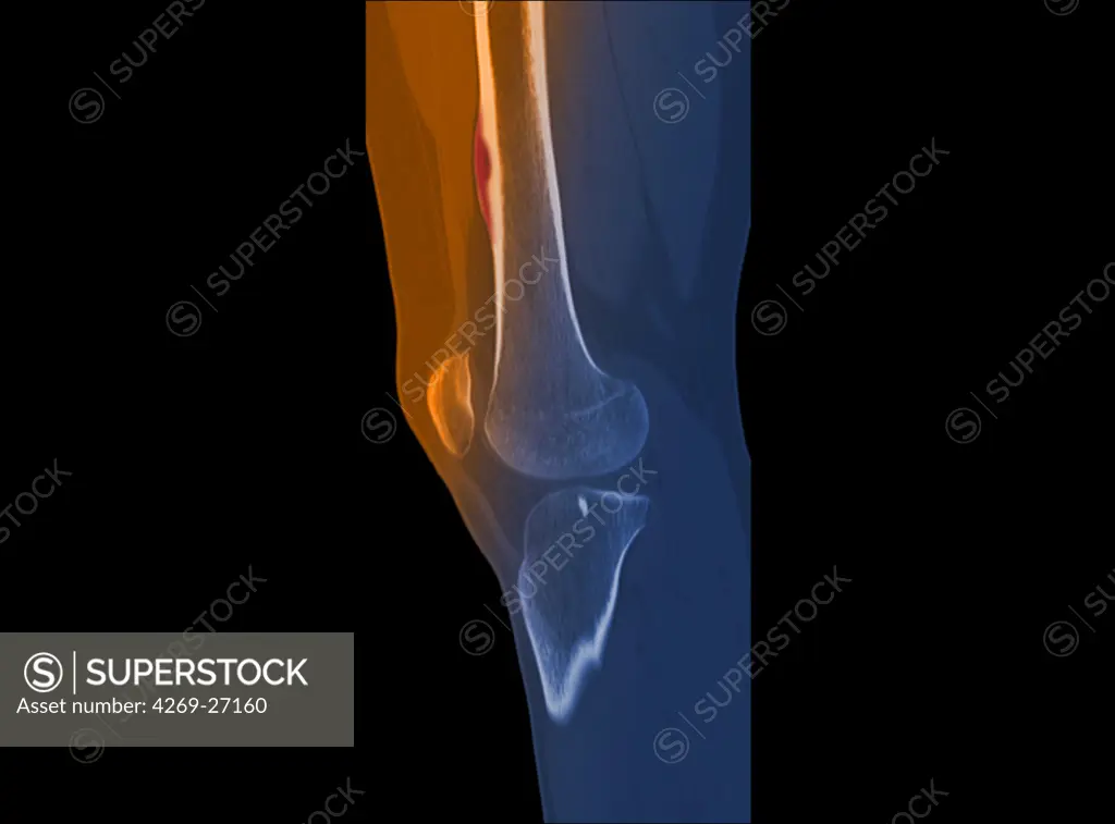 Osteoid osteoma. Color enhanced sagittal computed tomography (CT) scan of the thigh showing osteoid osteoma (benign bone tumor) on the femur. The osteoid osteoma is revealed by a thickening of the bone connective tissues (red) at the surface of the femur (white).