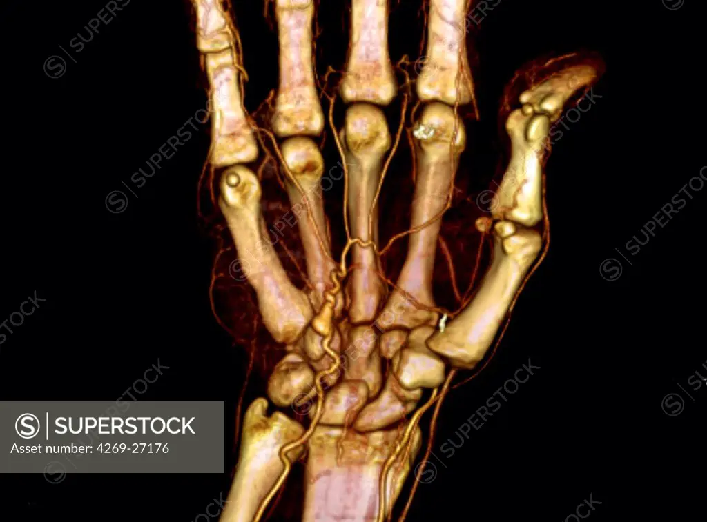 Hypothenar hammer syndrome. 3D computed tomography (CT) scan of a right hand with hypothenar hammer syndrome (HHS).