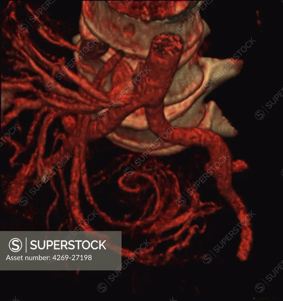 Intestinal obstruction. 3D Computed Tomography (CT) reconstruction scan of the vascularization of the abdomen showing signs of whorls of the small intestine responsible for a bowel obstruction. It is evidenced by the winding of the blood vessels of the intestine's loops around their axis (bottom).