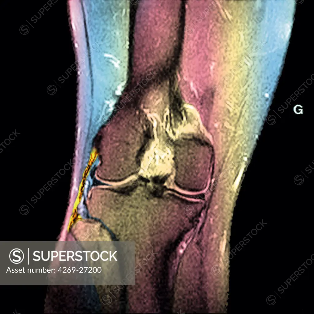 Knee. Sagittal frontal Magnetic Resonance Image (MRI) of the right knee showing the tibial collateral ligament (yellow), between the femur and the fibula.