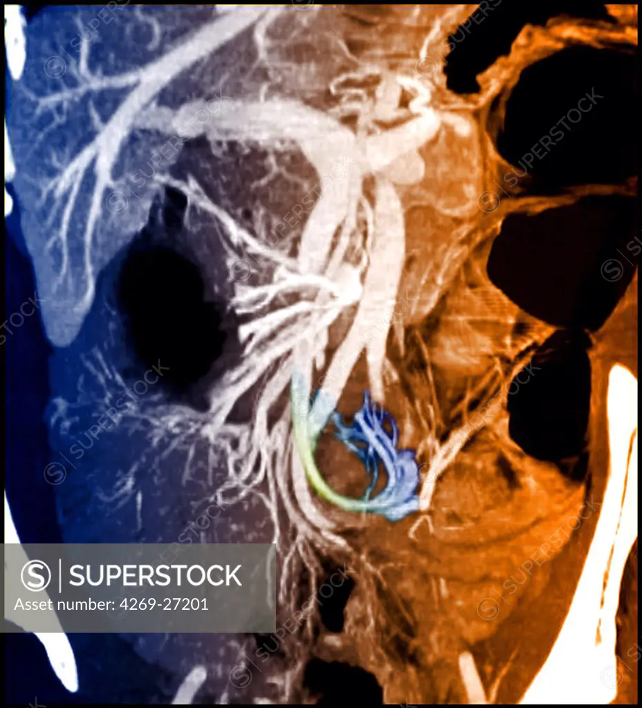 Intestinal obstruction. Frontal sagittal Computed Tomography (CT) scan of the vascularization of the abdomen (in white) showing signs of whorls of the small intestine, responsible for a bowel obstruction. It is evidenced by the winding of the blood vessels of the intestine's loops around their axis (in blue at bottom).