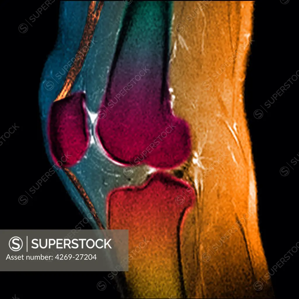 Knee. Sagittal (side view) Magnetic Resonance Image (MRI) of the knee showing in orange the patellar tendon (between the patella and the tibia above), and the flexing quadriceps tendon (between the patella and the femur below). The distal femur (above), the proximal tibia (below), and the patella or knee cap (left) are in red.