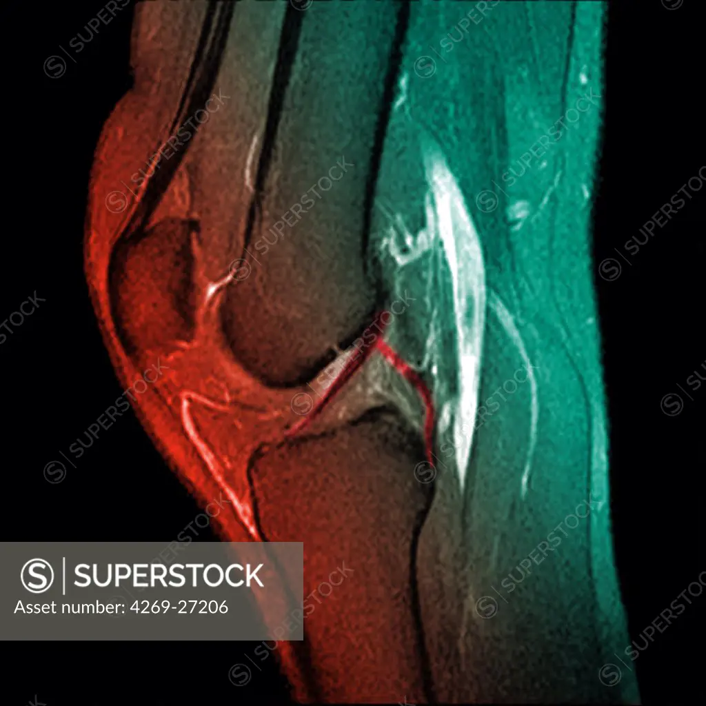 Knee. Sagittal (side view) Magnetic Resonance Image (MRI) of the knee showing the anterior and posterior cruciate ligaments (in red). The distal femur (above), the proximal tibia (below), and the patella or knee cap (left) are dark red.
