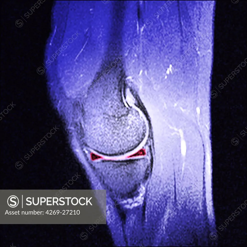Meniscus. Sagittal Magnetic Resonance Image (MRI) of the knee showing the meniscus (two red triangles). The patella or knee cap (above) and the proximal tibia (below) are in purple.