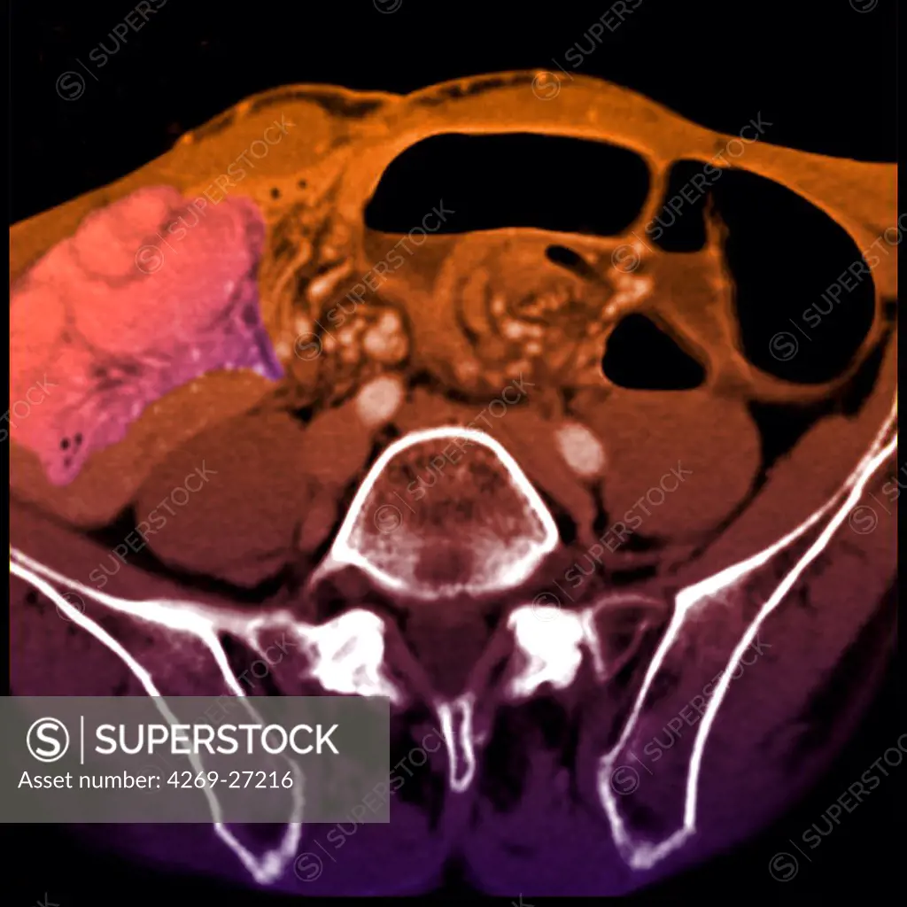 Intestinal obstruction. Colored enhanced Axial Computed Tomography (CT) scan of the abdomen showing signs of whorls (volvulus) of the small intestine, responsible for a bowel obstruction. It is evidenced by the winding of the intestine's loops around their axis, in pink at left.