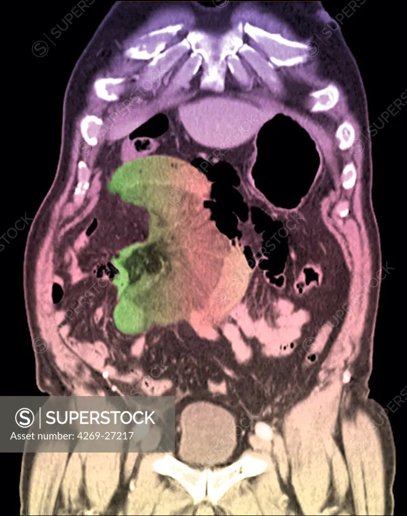 Intestinal obstruction. Color enhanced sagittal Computed Tomography (CT) scan of the abdomen showing a volvulus of the colon responsible for a bowel obstruction. It is evidenced by the winding of the colon loops (green circular shape) around their axis (in black at center of the loops).