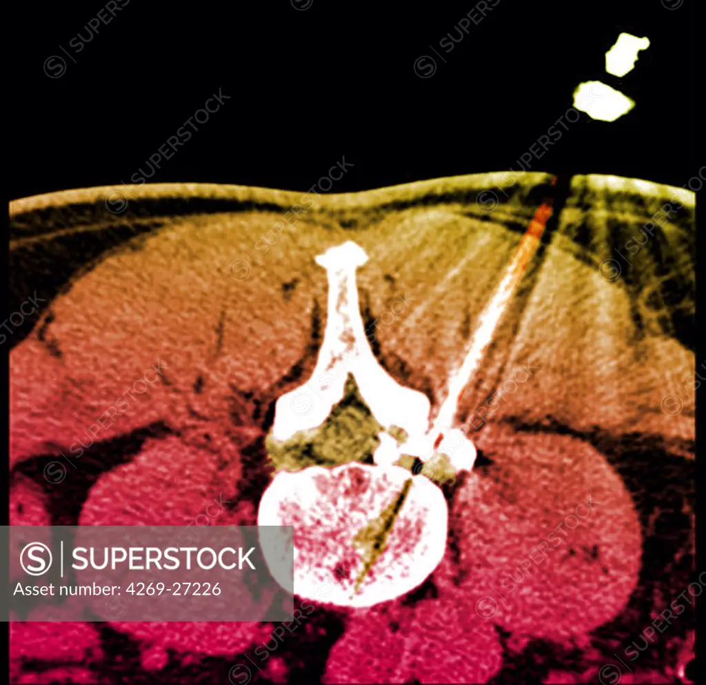 Vertebral infiltration. Color enhanced axial Computed Tomography (CT) scan of a lumbar vertebra with arthrosis treated by infiltration of anti-inflammatory drug (corticoids) around the spinal cord and spinal nerve. The needle (in white at right) is inserted into the vertebral foramen (foraminal infiltration).
