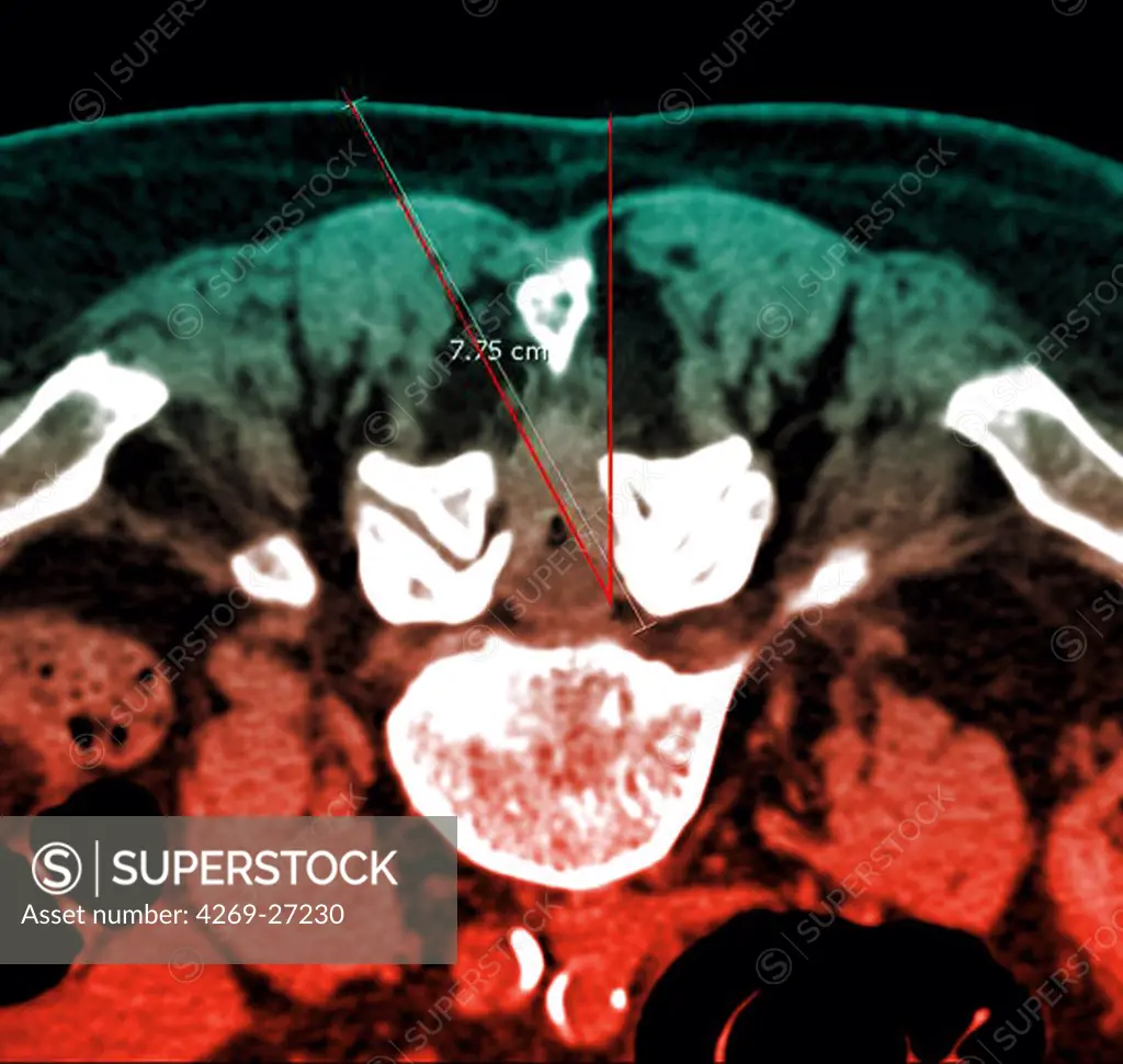 Vertebral infiltration. Color enhanced axial Computed Tomography (CT) scan of a lumbar vertebra with arthrosis treated by infiltration of anti-inflammatory drug (corticoids) around the spinal cord and spinal nerve. The needle, which route is marked in red, will be inserted into the vertebral foramen (foraminal infiltration), but throught the vertebral canal.