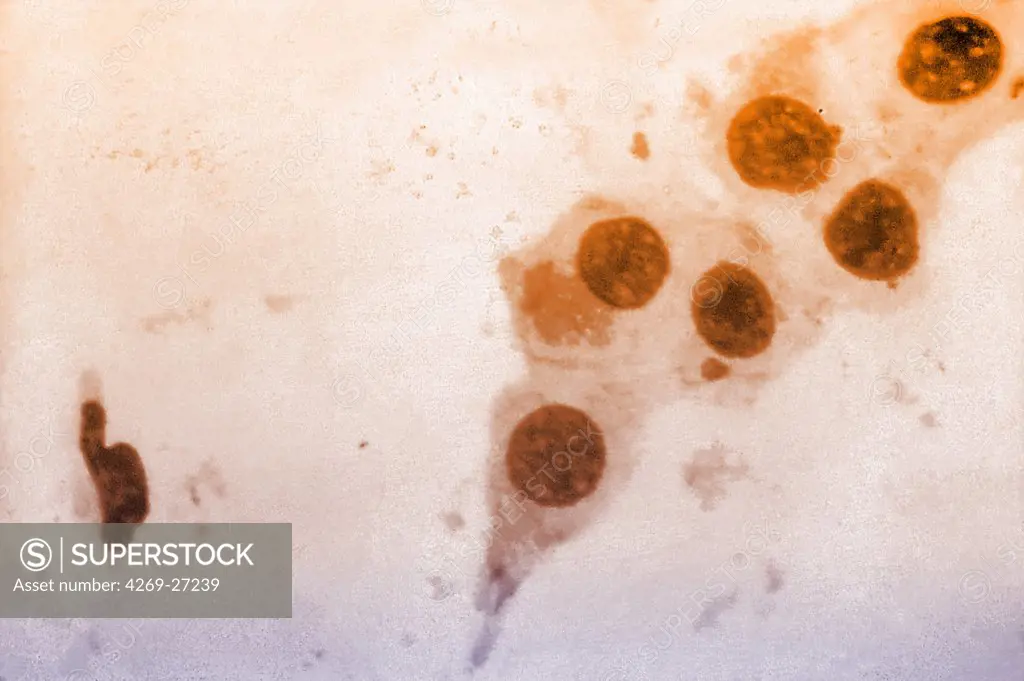 Chlamydia trachomatis. Light photomicrograph of Chlamydia trachomatis taken from a urethral scrape. This parasitic bacterium is responsible for the sexually transmitted disease lymphogranuloma venereum, eye diseases like trachoma and inclusion conjunctivitis and urethritis.