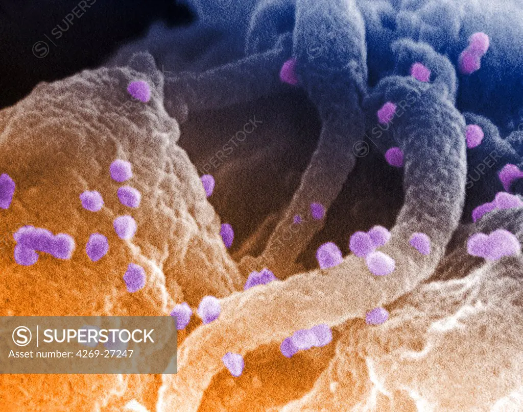AIDS virus. Scanning electron micrograph (SEM) of human immunodeficiency virus (HIV-1) appearing as small spheres on the surface of a lymphocyte.