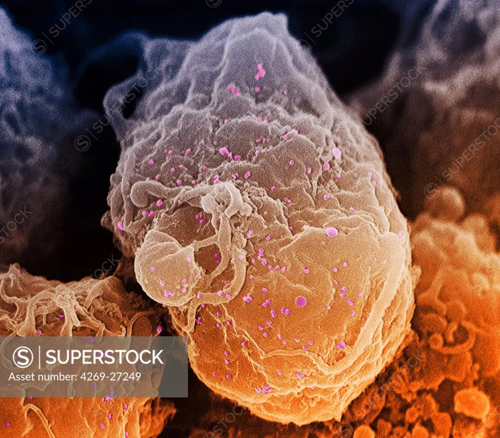 AIDS virus. Scanning electron micrograph (SEM) of human immunodeficiency virus (HIV-1) appearing as small spheres on the surface of a lymphocyte.