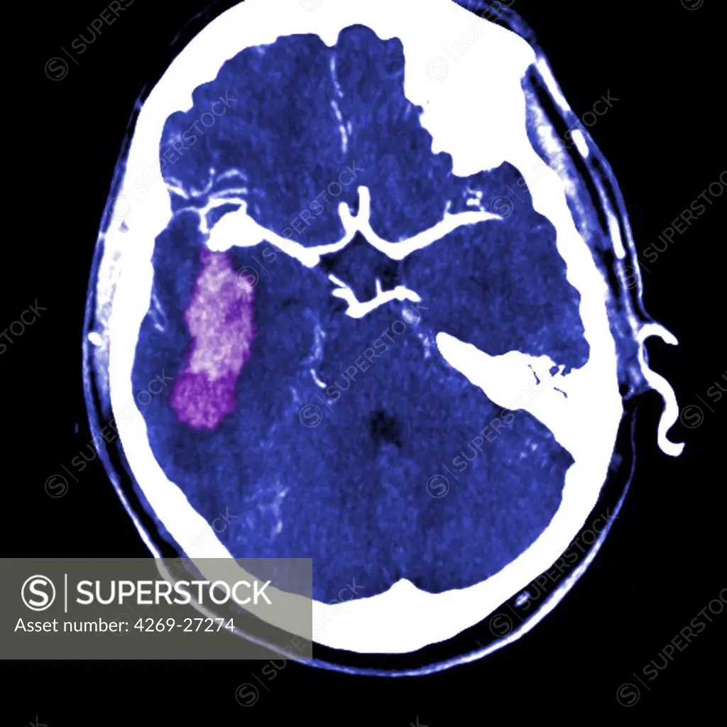 Cerebral aneurysm. Computed Tomography (CT) scan of the brain showing a ruptured intracranial aneurysm with hemorrhage (stroke). The aneurysm is the white shape at left, the gemorrhage is seen in pink. An aneurysm is a bulge of a vessel due to the dilatation of its wall. A ruptured aneurysm can be fatal.