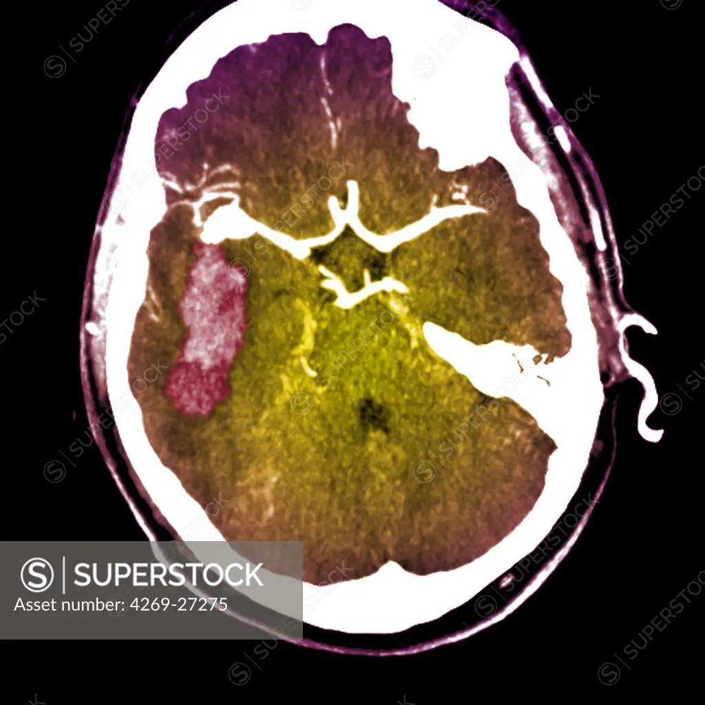 Cerebral aneurysm. Computed Tomography (CT) scan of the brain showing a ruptured intracranial aneurysm with hemorrhage (stroke). The aneurysm is the white shape at left, the gemorrhage is seen in pink. An aneurysm is a bulge of a vessel due to the dilatation of its wall. A ruptured aneurysm can be fatal.