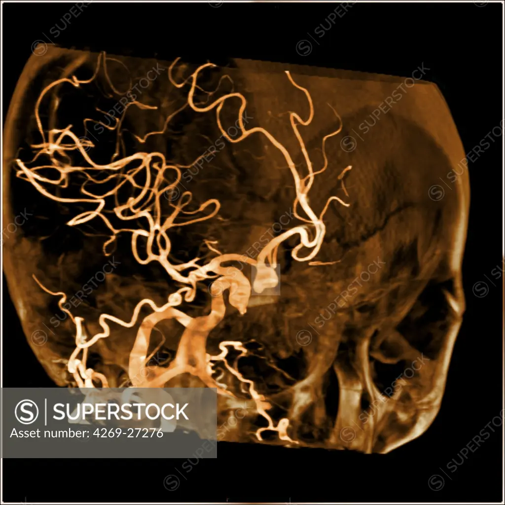 Cerebral aneurysm. 3D reconstruction from CT scanner and angiography of the skull and its vascularization system showing a brain aneurysm (square). An aneurysm is a bulge of a vessel due to the dilatation of its wall. A ruptured aneurysm can be fatal.