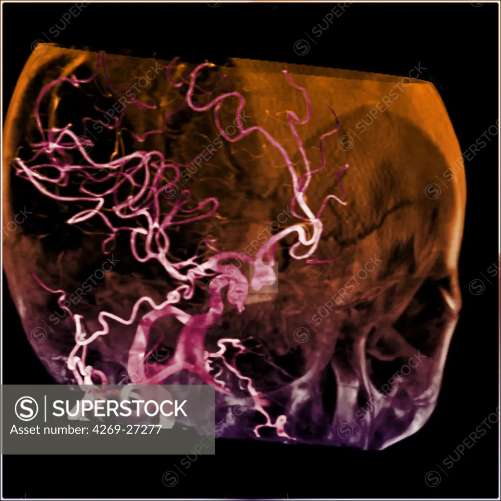 Cerebral aneurysm. 3D reconstruction from CT scanner and angiography of the skull and its vascularization system showing a brain aneurysm (square). An aneurysm is a bulge of a vessel due to the dilatation of its wall. A ruptured aneurysm can be fatal.
