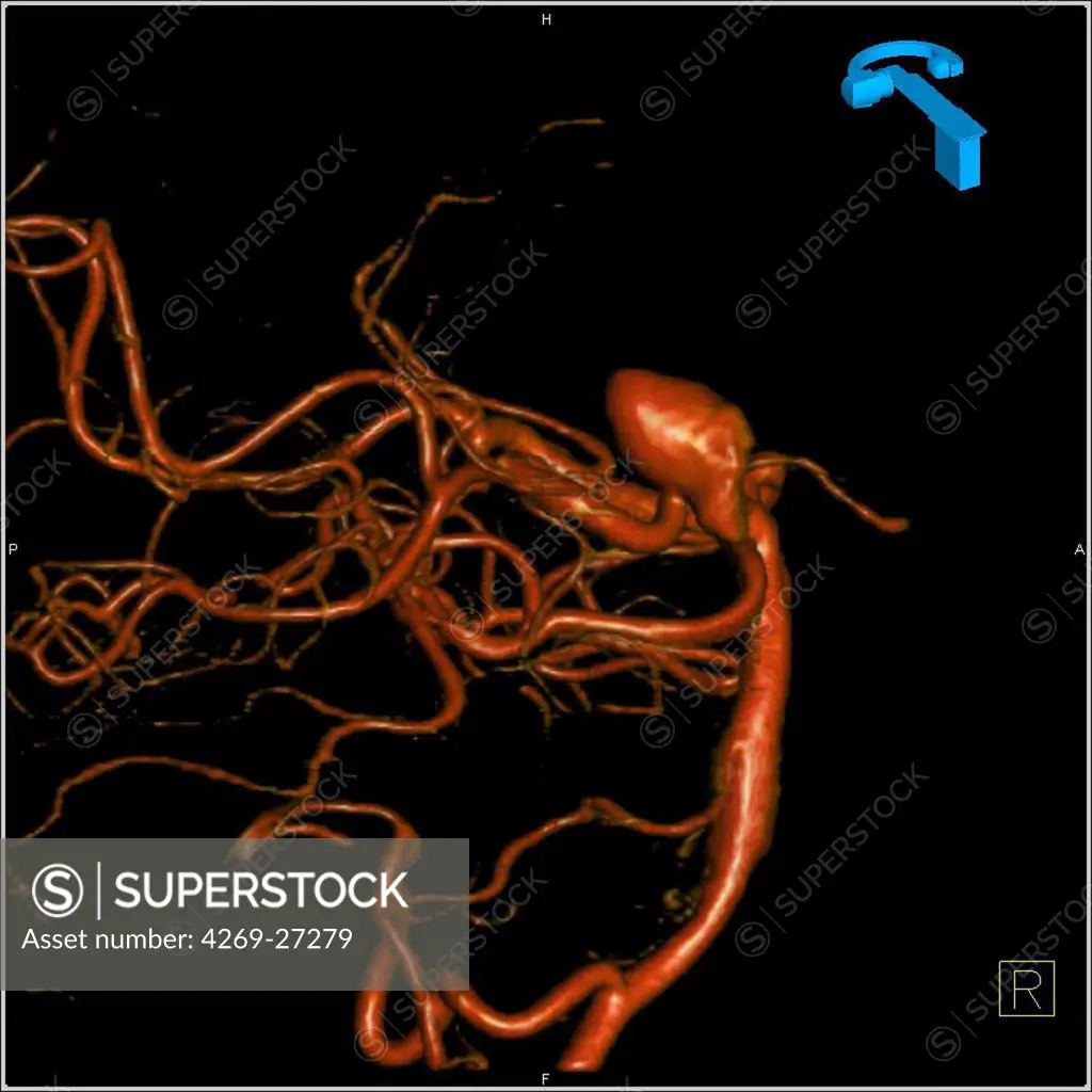 Cerebral aneurysm. 3D Computed Tomography (CT) scan reconstruction of an aneurysm of the right vertebral artery. An aneurysm is a bulge of a vessel due to the dilatation of its wall. A ruptured aneurysm can be fatal.