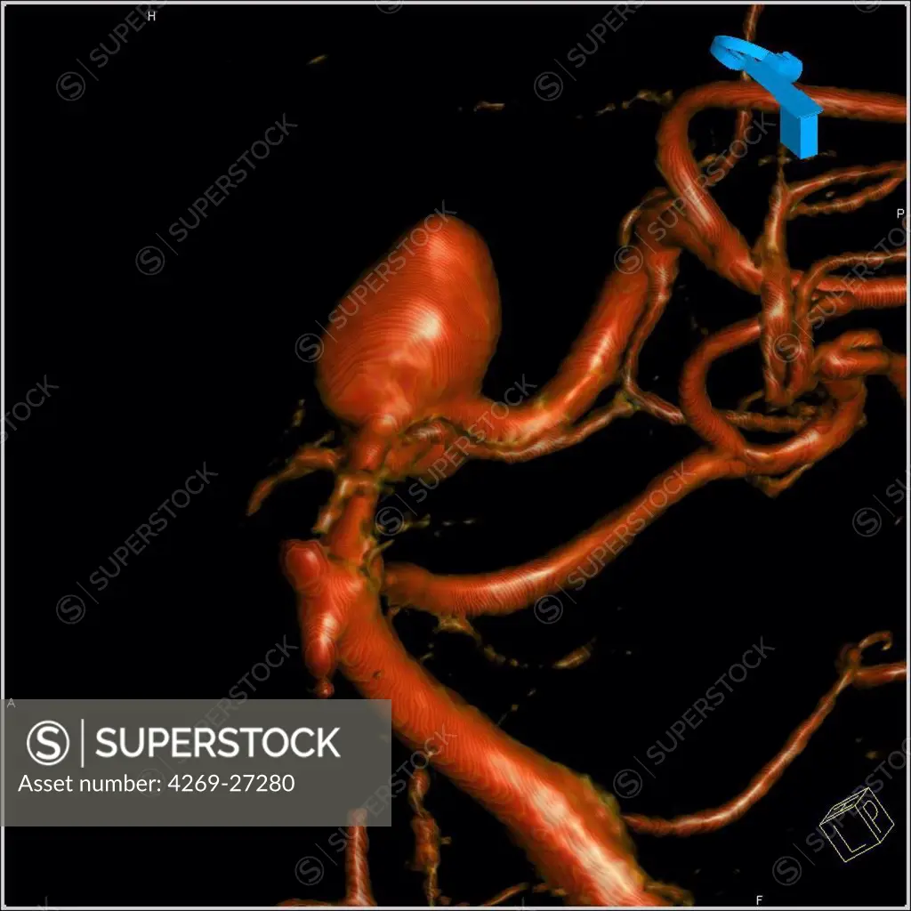 Cerebral aneurysm. 3D Computed Tomography (CT) scan reconstruction of an aneurysm of the left carotid artery (side view). An aneurysm is a bulge of a vessel due to the dilatation of its wall. A ruptured aneurysm can be fatal.