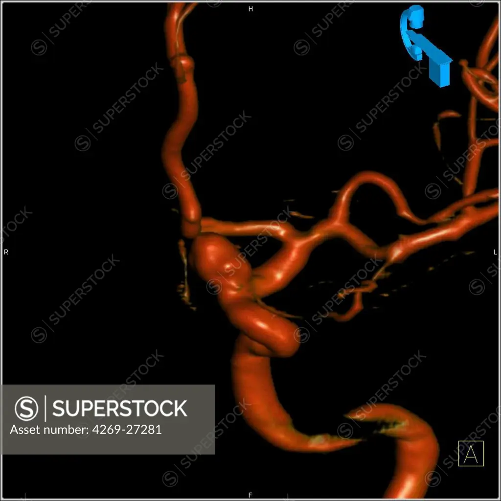 Cerebral aneurysm. 3D Computed Tomography (CT) scan reconstruction of an aneurysm of the left carotid artery (front view). An aneurysm is a bulge of a vessel due to the dilatation of its wall. A ruptured aneurysm can be fatal.