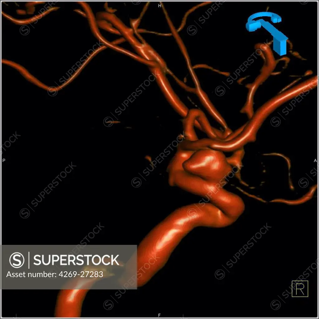 Cerebral aneurysm. 3D Computed Tomography (CT) scan reconstruction of an aneurysm of the left carotid artery. An aneurysm is a bulge of a vessel due to the dilatation of its wall. A ruptured aneurysm can be fatal.