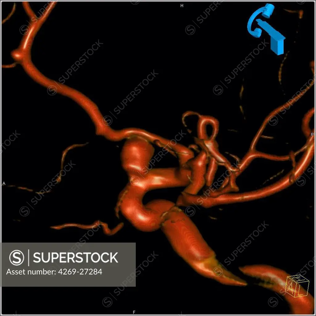 Cerebral aneurysm. 3D Computed Tomography (CT) scan reconstruction of a small aneurysm of the left carotid artery. An aneurysm is a bulge of a vessel due to the dilatation of its wall. A ruptured aneurysm can be fatal.
