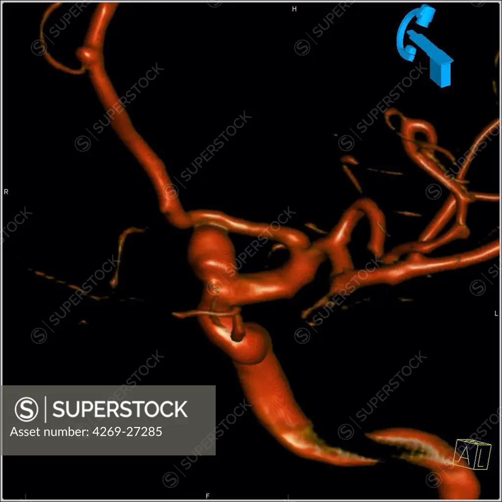 Cerebral aneurysm. 3D Computed Tomography (CT) scan reconstruction of a small aneurysm of the left carotid artery. An aneurysm is a bulge of a vessel due to the dilatation of its wall. A ruptured aneurysm can be fatal.