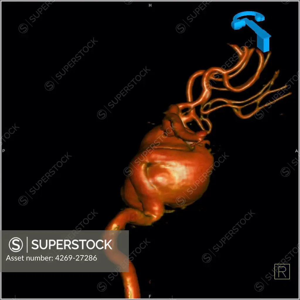 Cerebral aneurysm. 3D Computed Tomography (CT) scan reconstruction of a giant aneurysm of the right carotid artery. An aneurysm is a bulge of a vessel due to the dilatation of its wall. A ruptured aneurysm can be fatal.