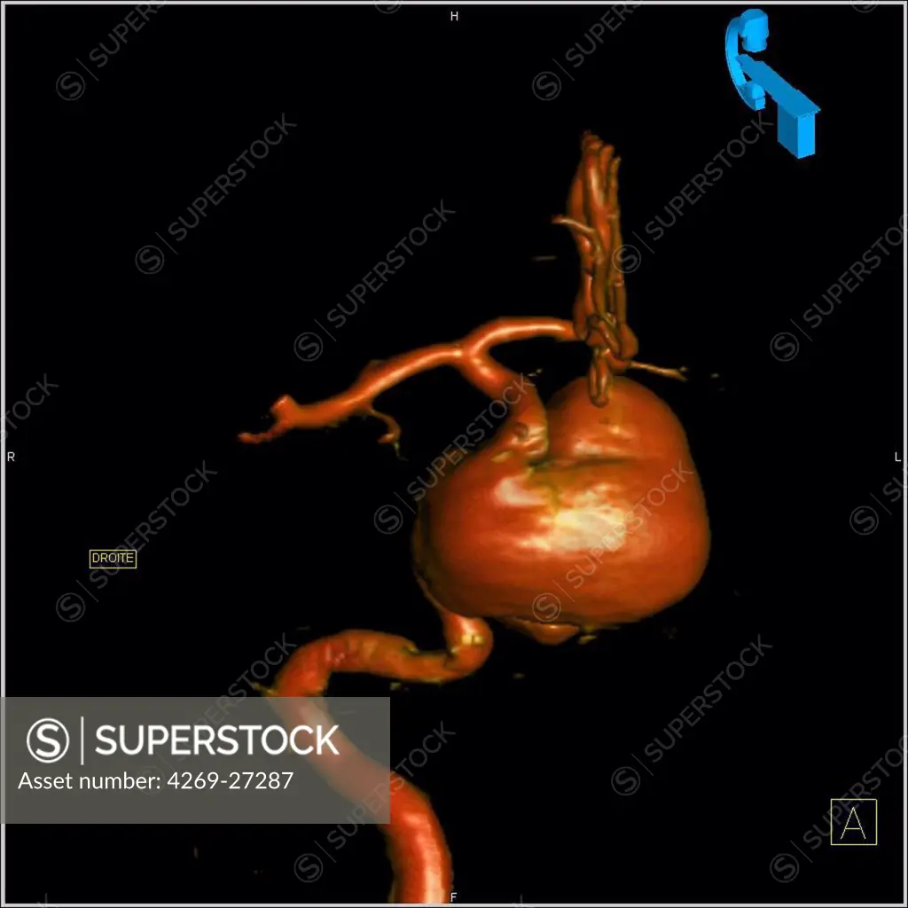 Cerebral aneurysm. 3D Computed Tomography (CT) scan reconstruction of a giant aneurysm of the right carotid artery. An aneurysm is a bulge of a vessel due to the dilatation of its wall. A ruptured aneurysm can be fatal.