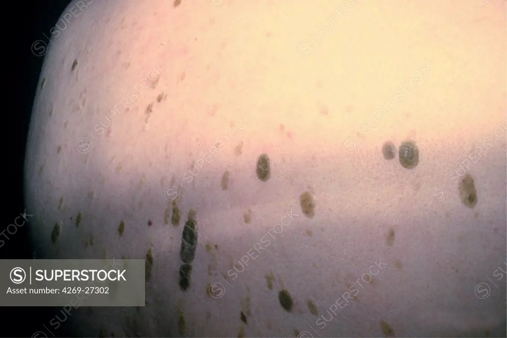 Seborrhoeic dermatitis. Seborrhoeic dermatitis on the back of a man.