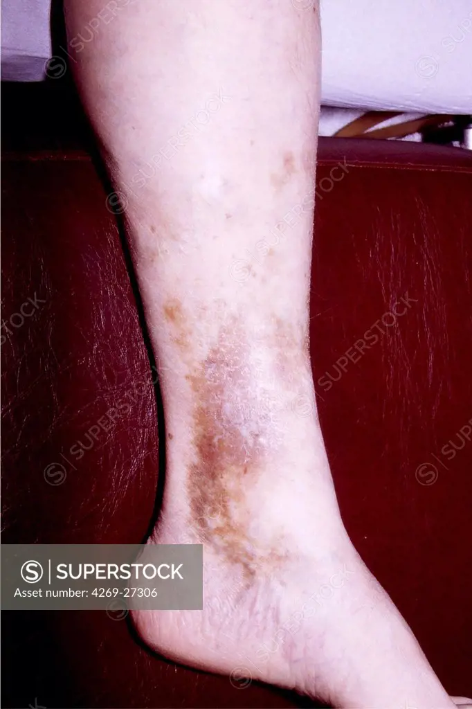 Pigmented dermatitis. Pigmented dermatitis on the ankle of elderly person, often related to venous insufficiency.