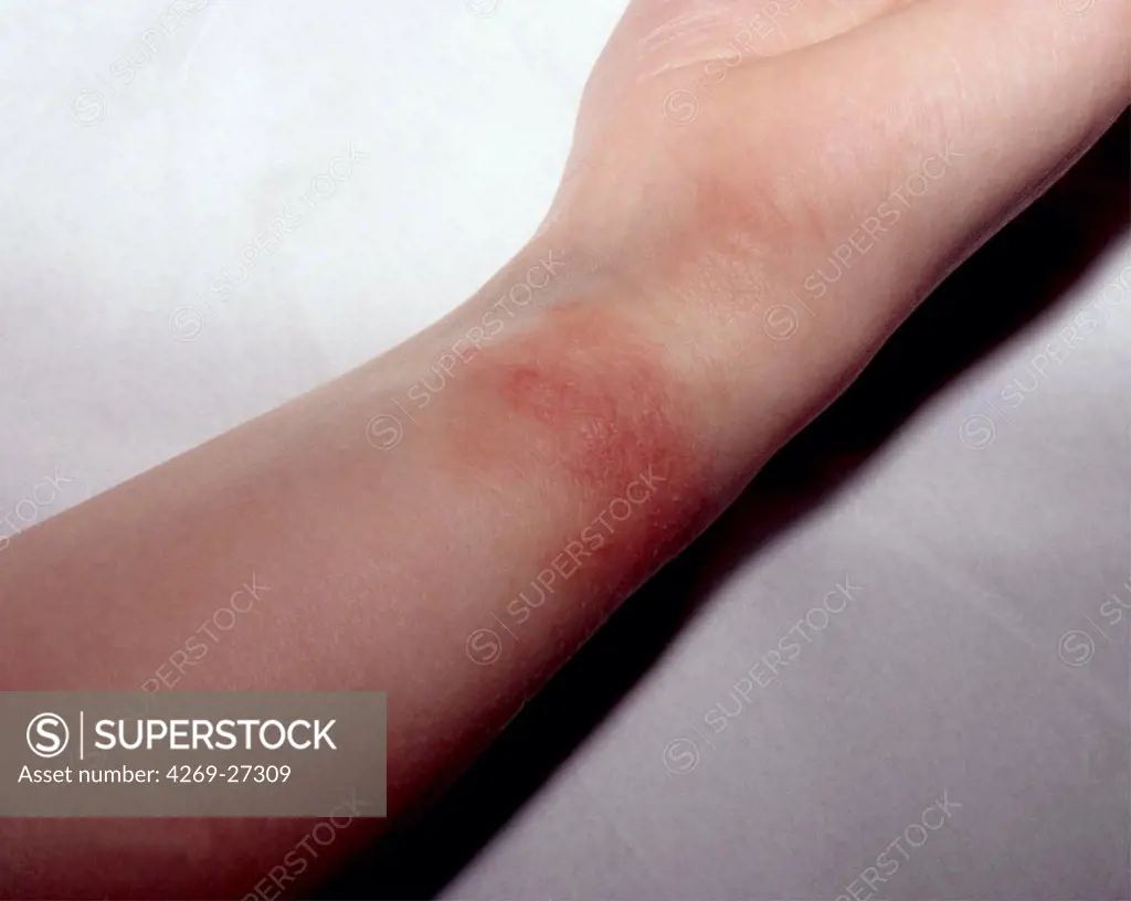 Eczema. Eczema on the wrist of a woman, a skin allergy to the metal of a bracelet (nickel).