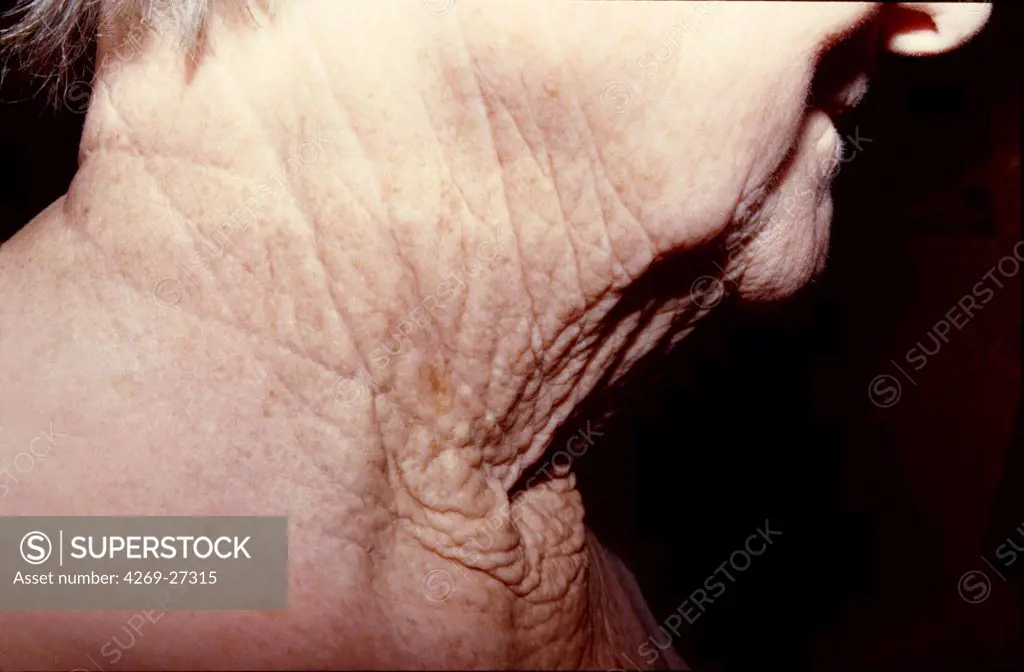 Solar elastose. Solar elastose of the skin of the neck of en elderly person.
