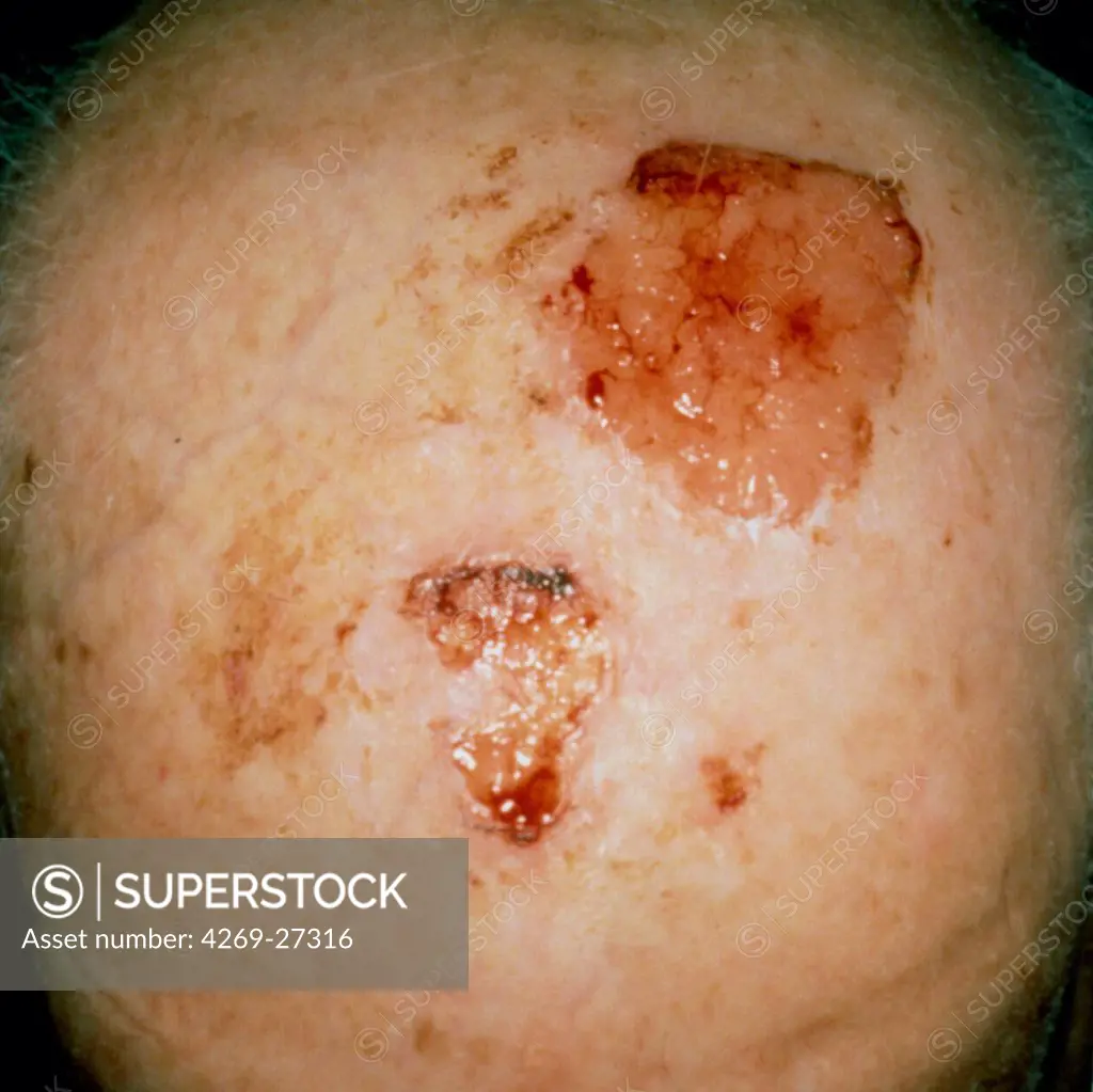 Basal cell carcinoma. Basal cell carcinoma (BCC), or rodent ulcer, on the scalp of elderly man.