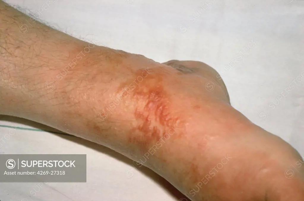 Erysipelas. Skin rash on the ankle of a patient caused by erysipelas.