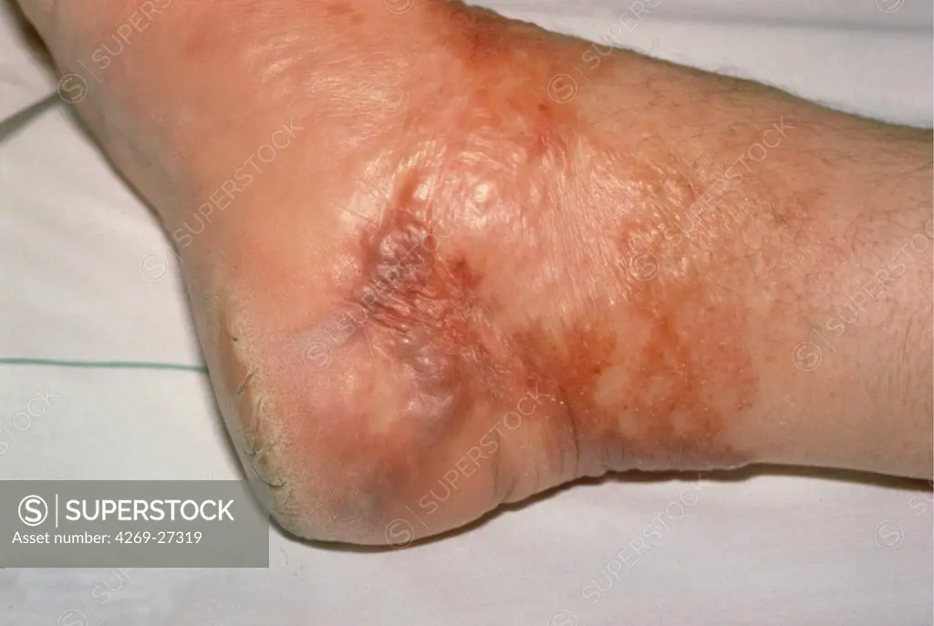 Erysipelas. Skin rash on the ankle of a patient caused by erysipelas.