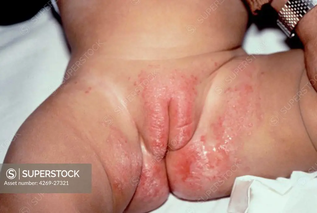 Diaper rash. Severe diaper rash on a young infant.