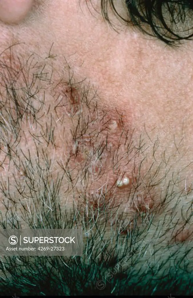 Folliculitis. Man suffering with folliculitis, a superficial infection of the hair follicles of the skin (beard), usually caused by the staphylococcus bacteria.