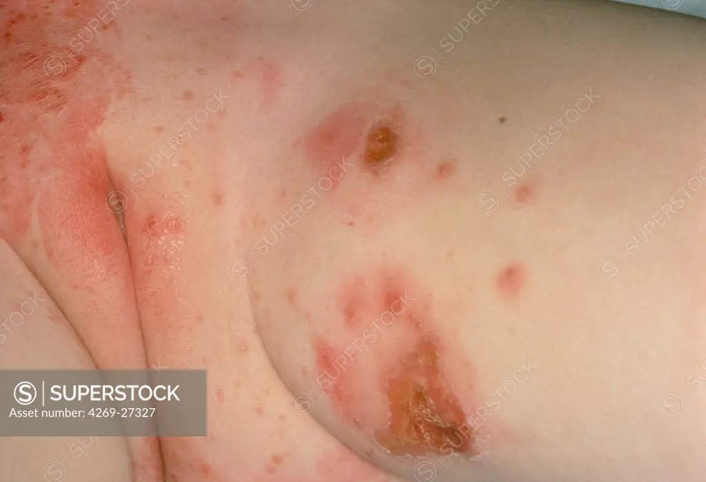 Impetigo. Impetigo rash on the skin of a baby. Impetigo is a highly contagious skin infection due to staphylococcus or streptococcus bacteria.