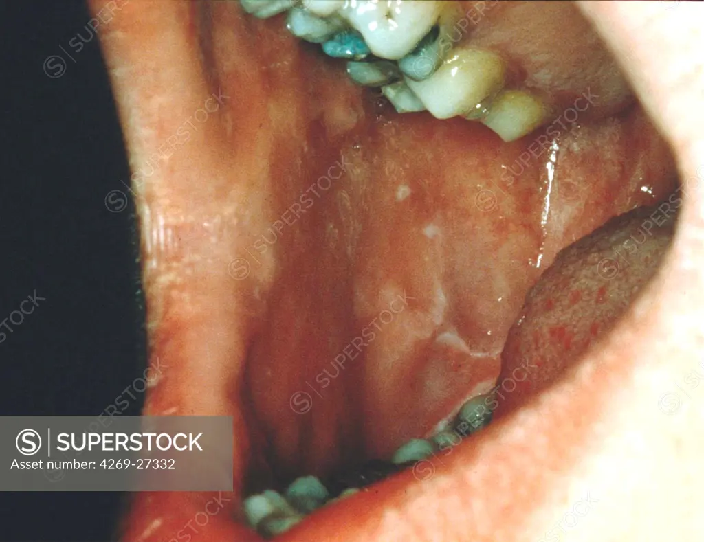 Mouth pathology. Buccal lichen.