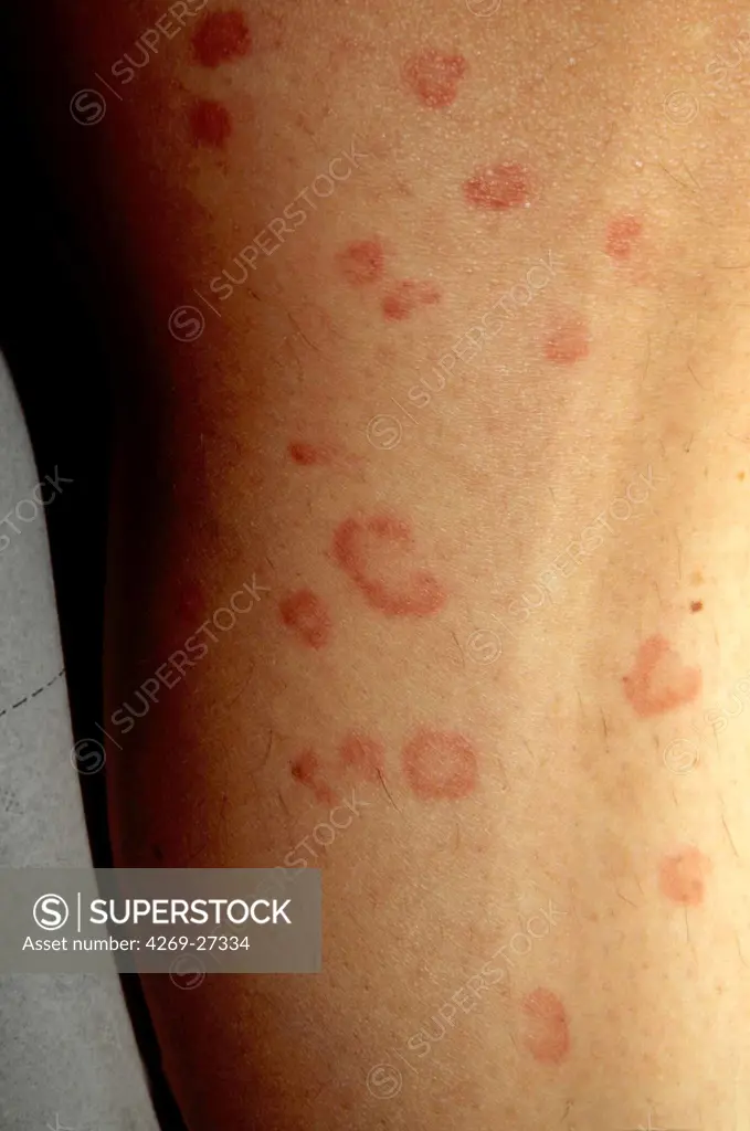 Fifth disease. Red rash on a woman's tighs, known as 'slapped cheek' or Fifth disease. Also called erythema infectiosum, this infectious disease caused by the parvovirus B19.