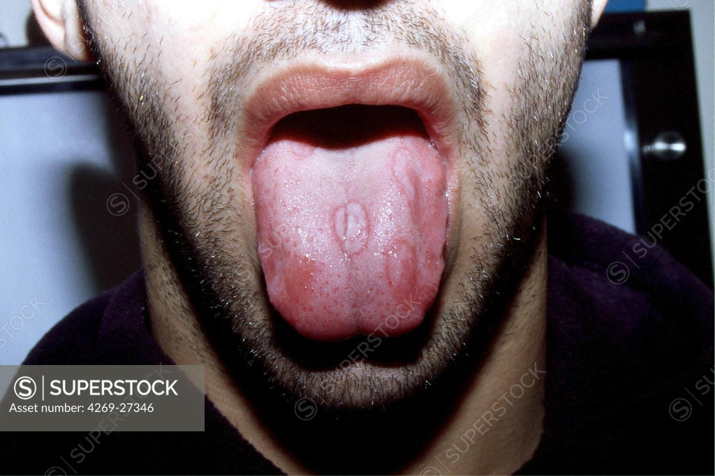 Syphilis. Secondary syphilitic chancre (ulcer) on the tongue of man ...