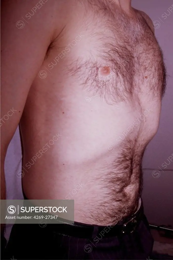 Syphilis. Syphilide (skin manifestation of syphilis) : roseola on the sides of a man with secondary syphilis.