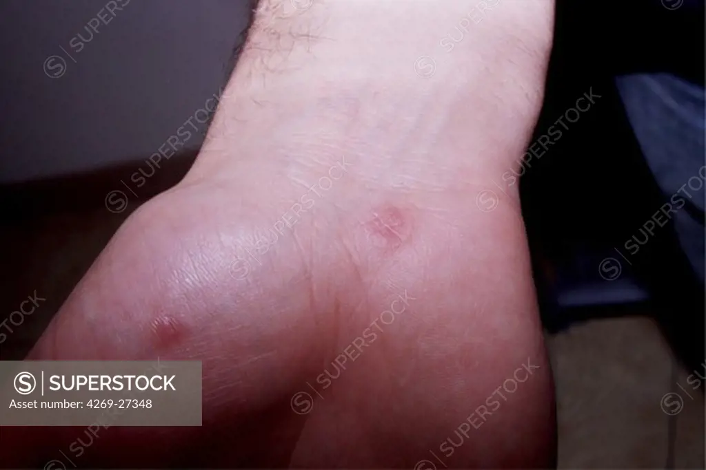 Syphilis. Papular syphilide : skin lesions on the palm of a man with secondary syphilis.