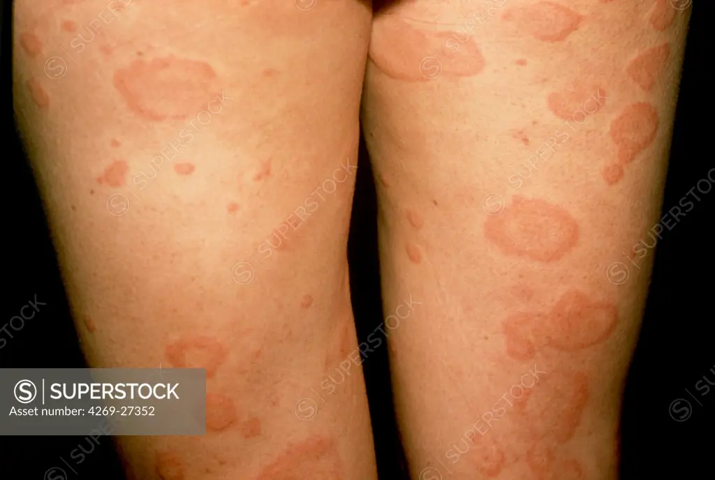 Urticaria. Urticaria rash (hives) on the thights of a woman.