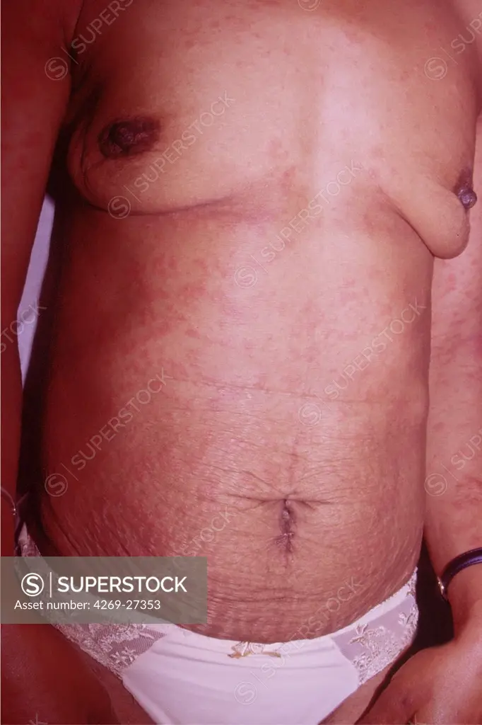Urticaria. Urticaria rash (hives) on the trunck of a woman.